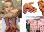 VẤN ĐỀ NHIỄM ĐỘC THẠCH TÍN TRONG NƯỚC NGẦM VÀ SỨC KHỎE CON NGƯỜI Ở VIỆT NAM