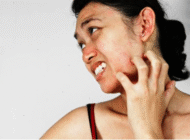 Dễ tái phát mề đay mẩn ngứa khi giao mùa