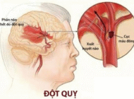 12 bệnh trọng liên quan đến rượu