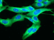 <b>Thử nghiệm vắc xin chống tái phát ung thư da</b><br />Kết quả ban đầu từ thử... Thử nghiệm vắc xin chống tái phát ung thư da