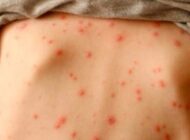 Khỏi thủy đậu vẫn chưa hết nguy cơ, virus có thể “ngủ đông” gây bệnh zona